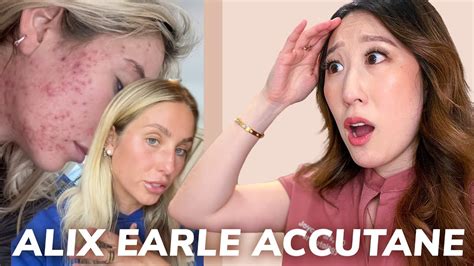 Dermatologist Reacts to Accutane Journey from Alix Earle